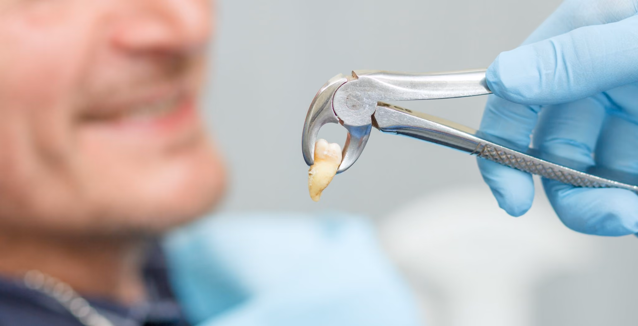 Wisdom teeth removal at Dentiq Dentistry in Houston, TX