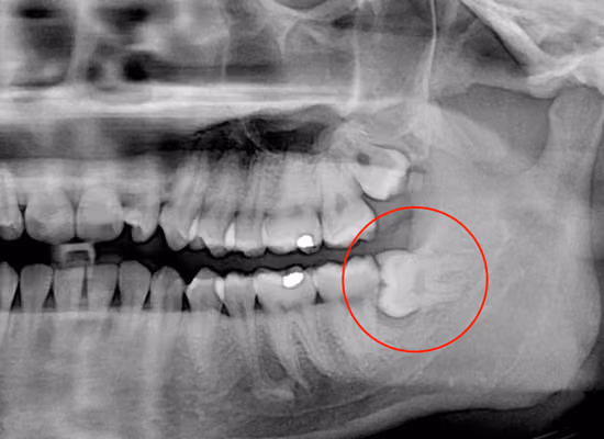 X-ray review before wisdom teeth removal at Dentiq Dentistry in Houston, TX