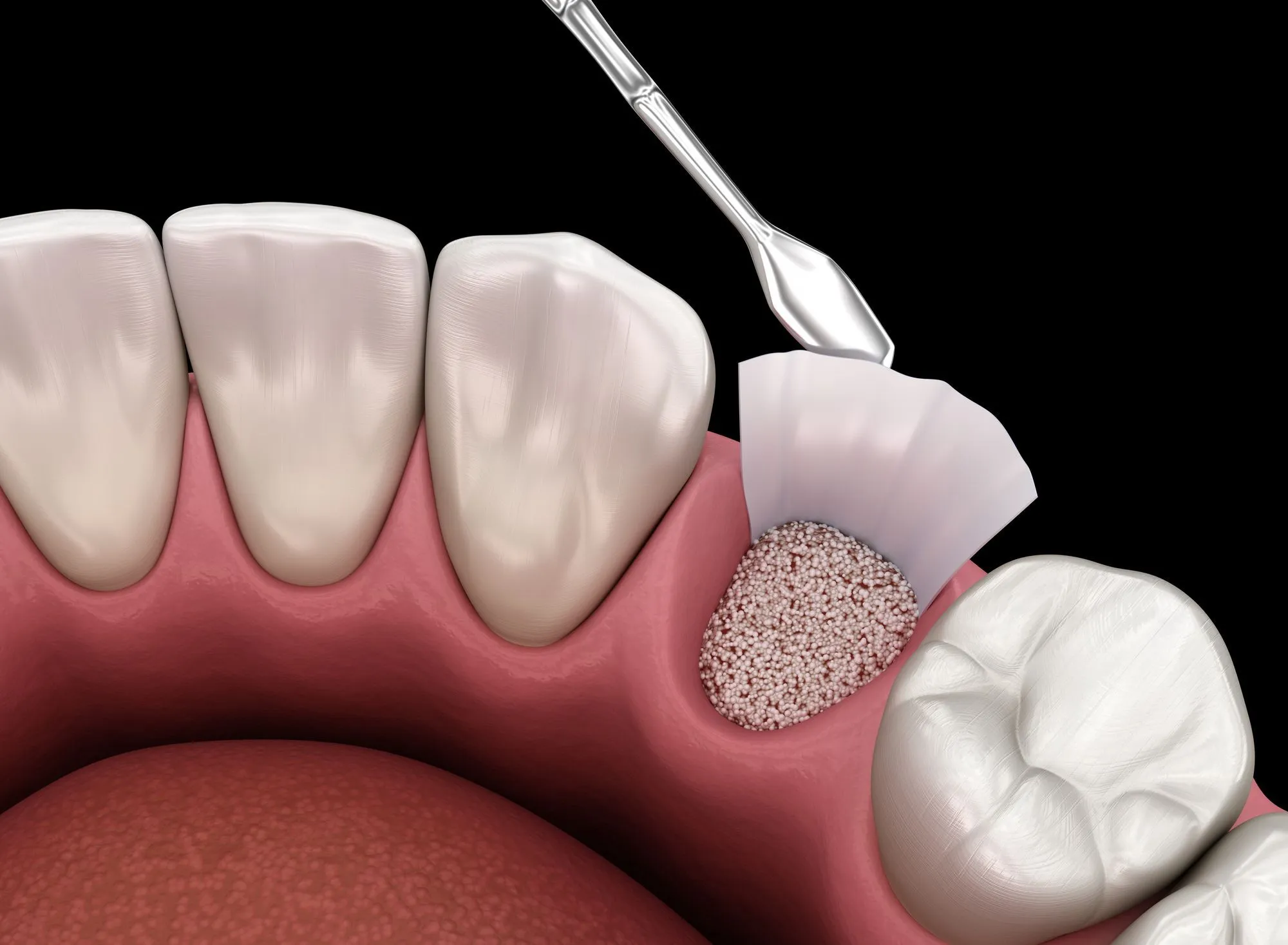 Diagram of jawbone rebuilt with grafting material to support a dental implant