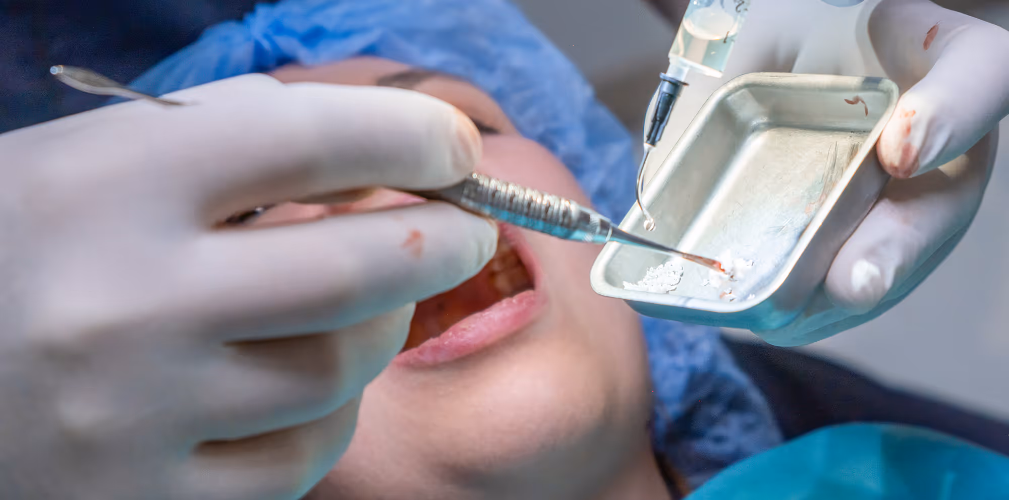 Bone grafting consultation for implant preparation at Dentiq Dentistry in Houston, TX