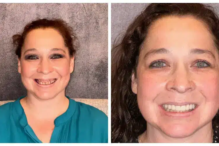Before and after porcelain veneers at Dentiq Dentistry Houston, case 2