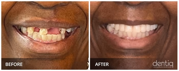 All-On-4 before and after full-arch restoration at Dentiq Dentistry Houston, case 7