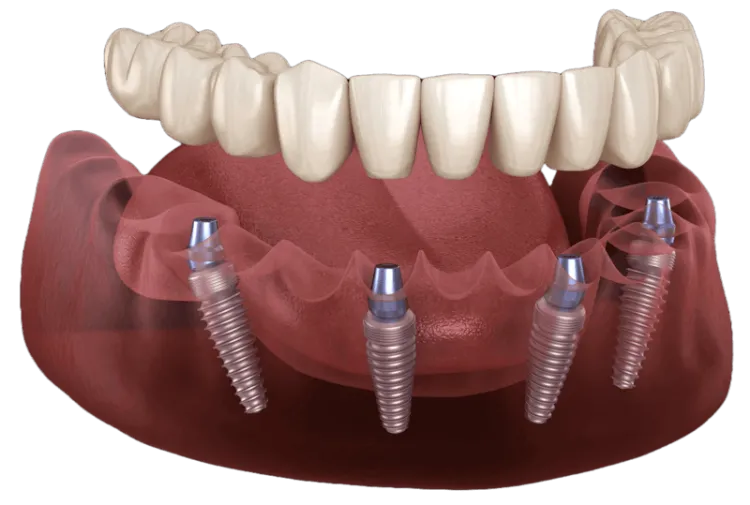 All-On-4 zirconia fixed full-arch restoration at Dentiq Dentistry Houston