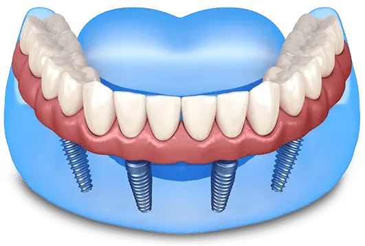 All-On-4 dental implant arch supported by four titanium posts