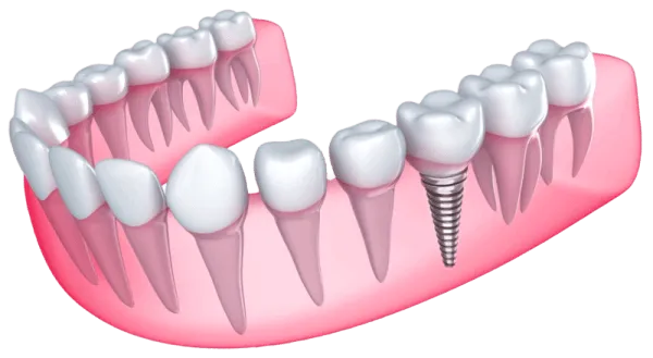 Individual dental implants replacing single teeth at Dentiq Dentistry Houston