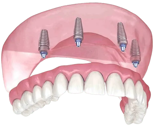 Implant supported denture at Dentiq Dentistry in Houston, TX