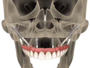 Zygomatic implants supporting a zirconia arch at Dentiq Dentistry Houston