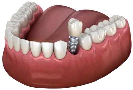 Single dental implant with abutment and crown at Dentiq Dentistry Houston