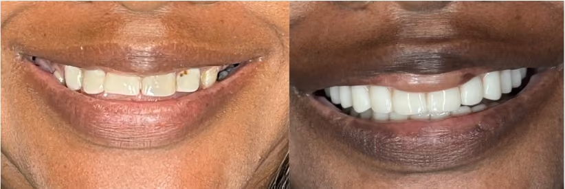 Close-up before and after smile restoration correcting worn and uneven front teeth, Dentiq Dentistry Houston