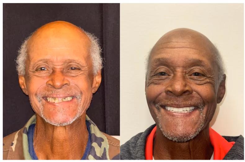 Before and after restoration of spaced and worn teeth into a full even smile, Dentiq Dentistry Houston