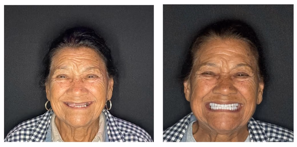 Before and after full smile restoration for a patient with missing teeth, Dentiq Dentistry Houston