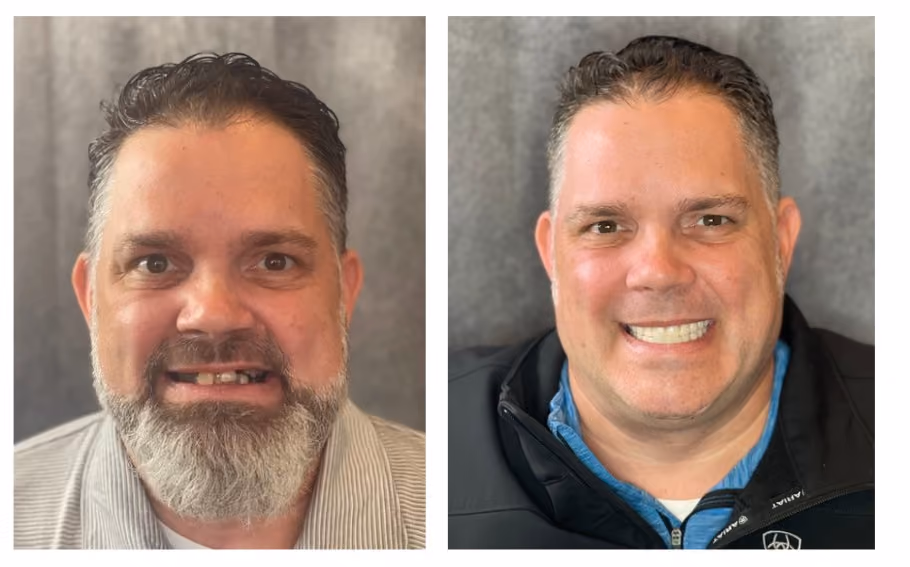 Before and after cosmetic treatment evening out discolored upper teeth, Dentiq Dentistry Houston