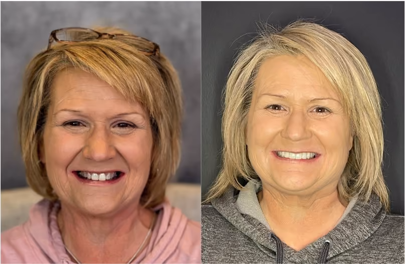 Before and after smile makeover brightening worn and discolored teeth, Dentiq Dentistry Houston