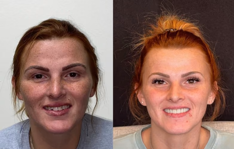 Before and after porcelain veneers at Dentiq Dentistry Houston, case 1