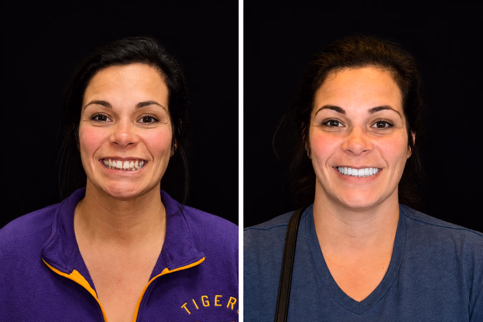 Before and after porcelain veneers at Dentiq Dentistry Houston, case 3