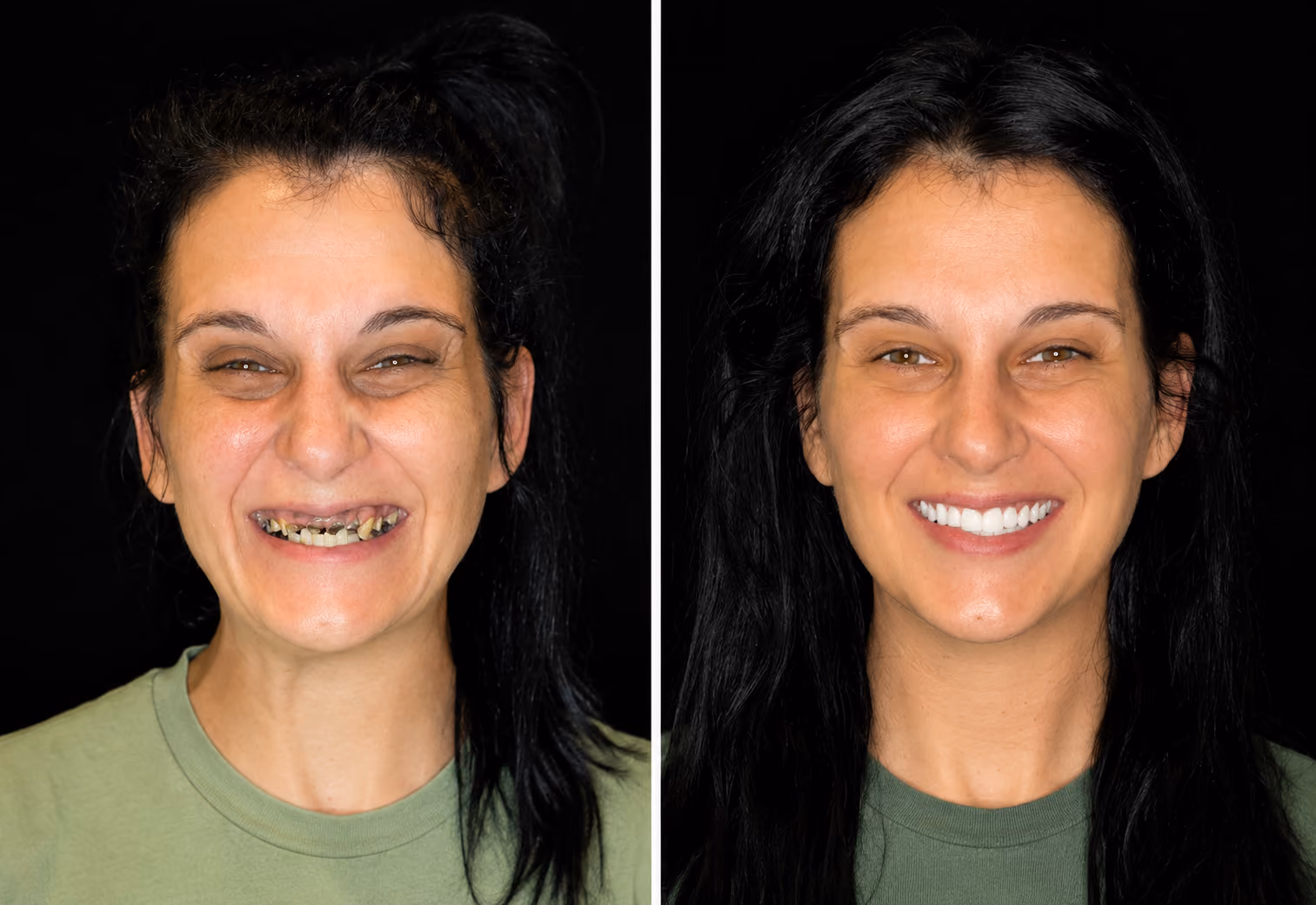 Before and after full smile makeover correcting severely damaged front teeth, Dentiq Dentistry Houston