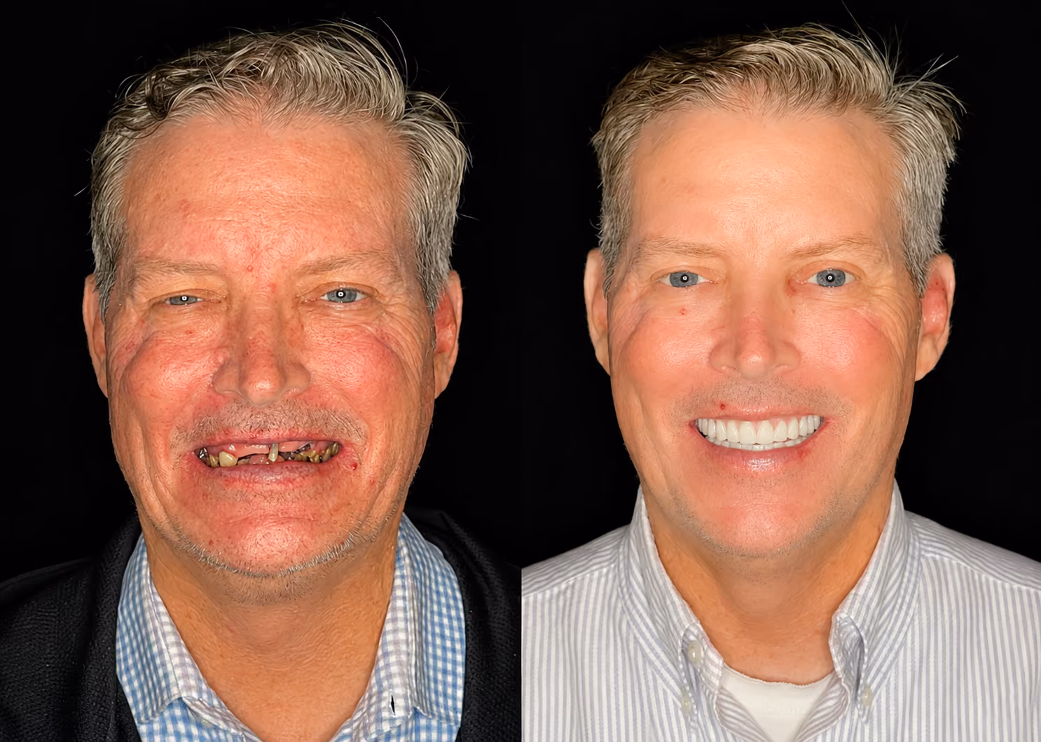 Before and after smile restoration replacing worn and missing upper teeth, Dentiq Dentistry Houston