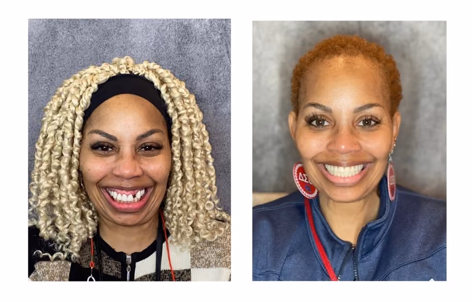 Before and after smile treatment closing gaps in the front teeth, Dentiq Dentistry Houston