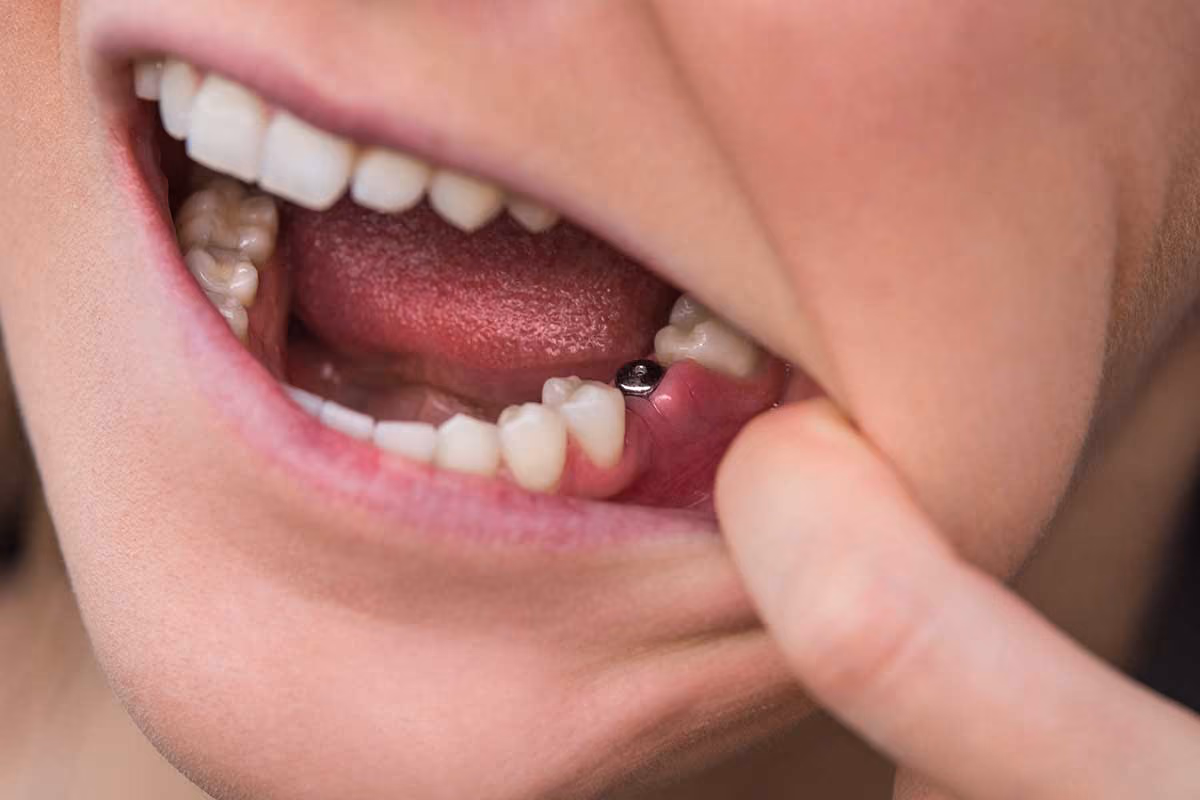 Single-tooth implant patient at Dentiq Dentistry Houston