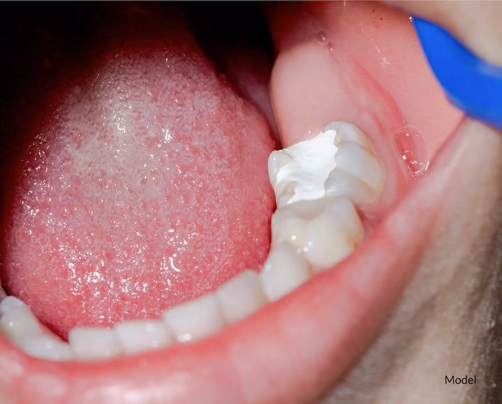 Tooth-colored composite filling being placed at Dentiq Dentistry in Houston, TX