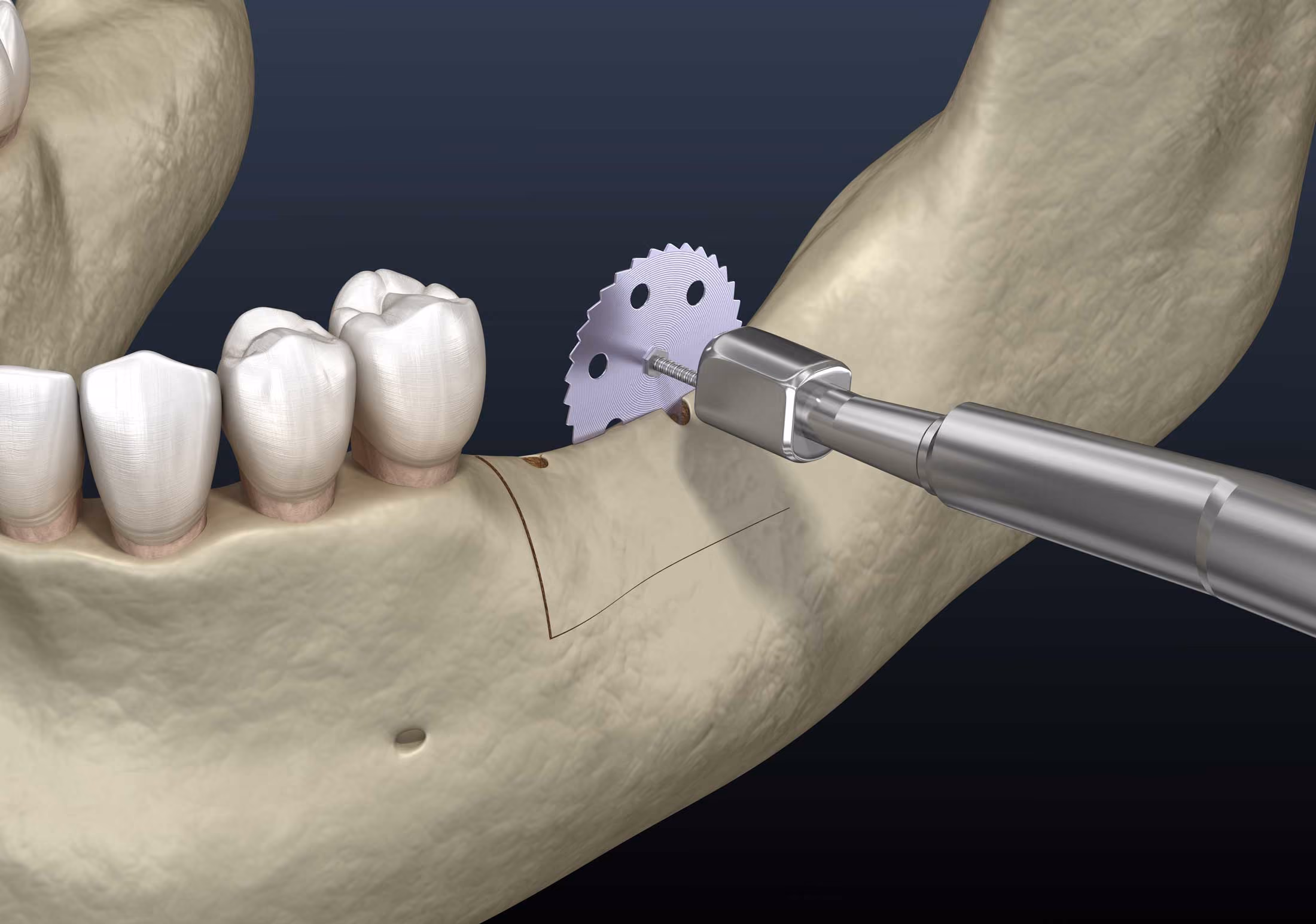Ridge augmentation procedure rebuilding jawbone contour at Dentiq Dentistry in Houston, TX