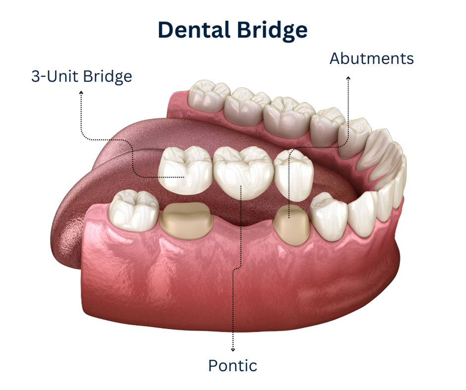 Dental bridge model at Dentiq Dentistry Houston