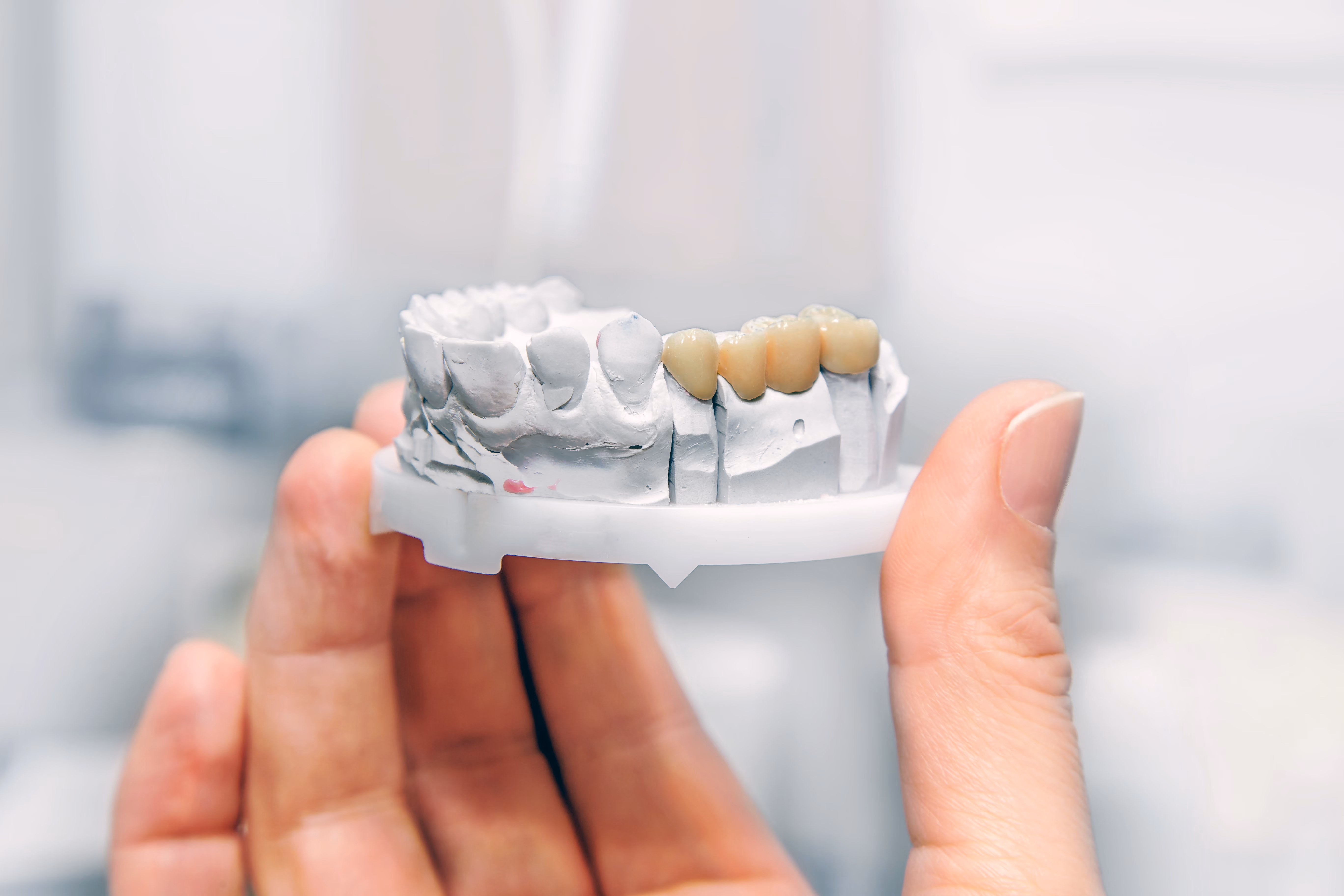 Dental bridges in Houston, TX at Dentiq Dentistry