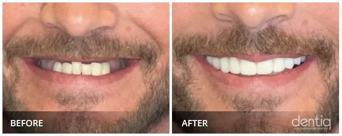 Close-up before and after porcelain veneers at Dentiq Dentistry Houston, case 4