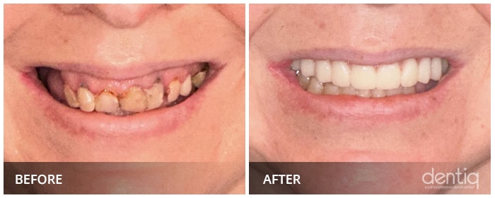 Close-up before and after porcelain veneers at Dentiq Dentistry Houston, case 5