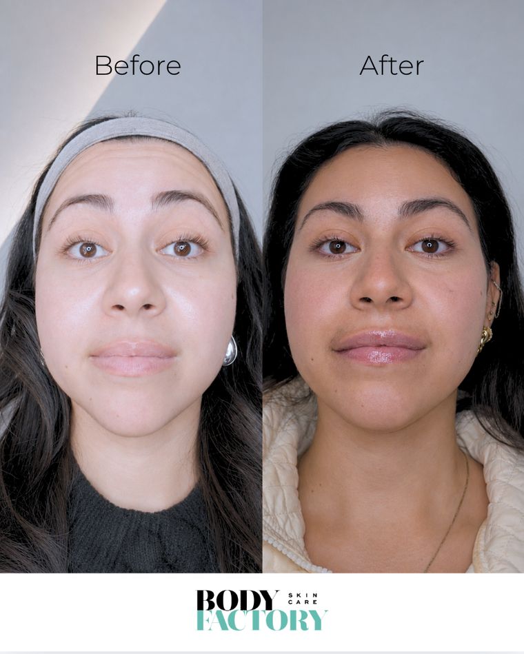 Wrinkle treatment before and after