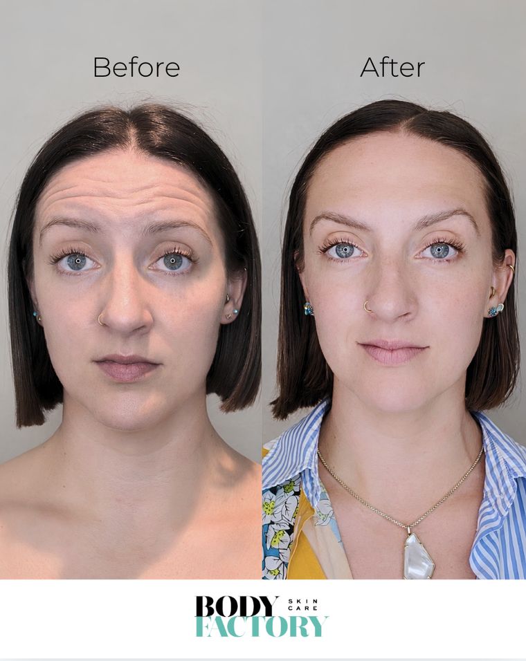 Wrinkle treatment before and after