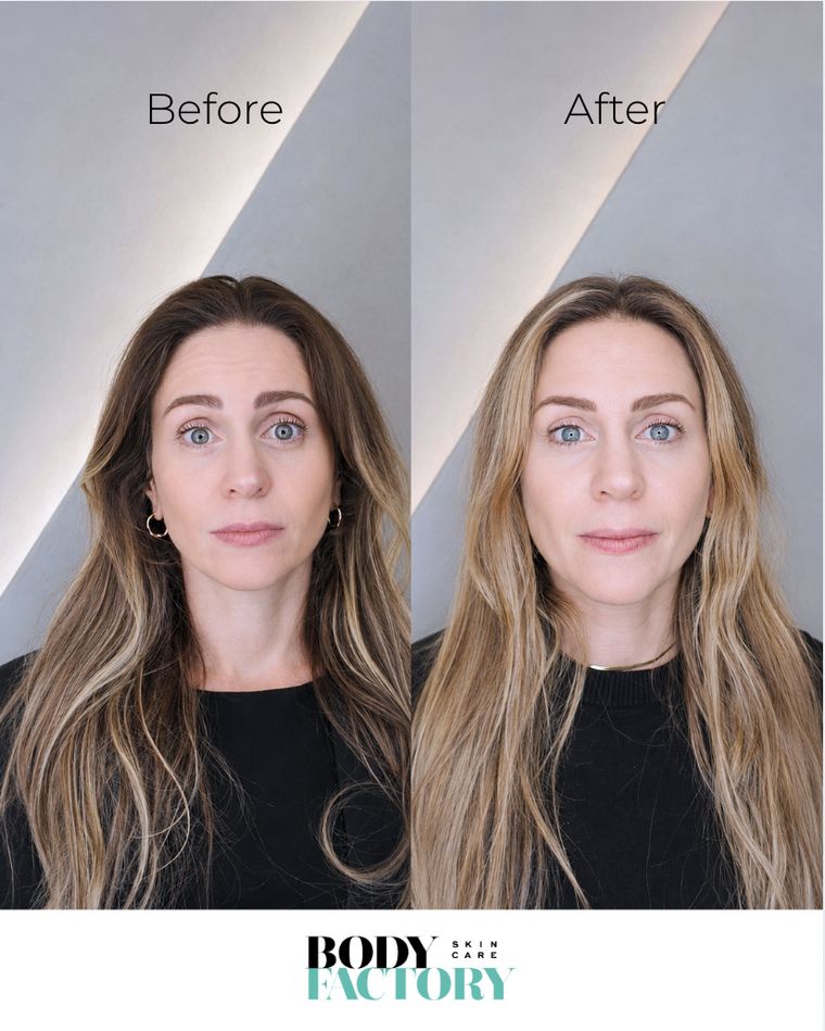 Wrinkle treatment before and after