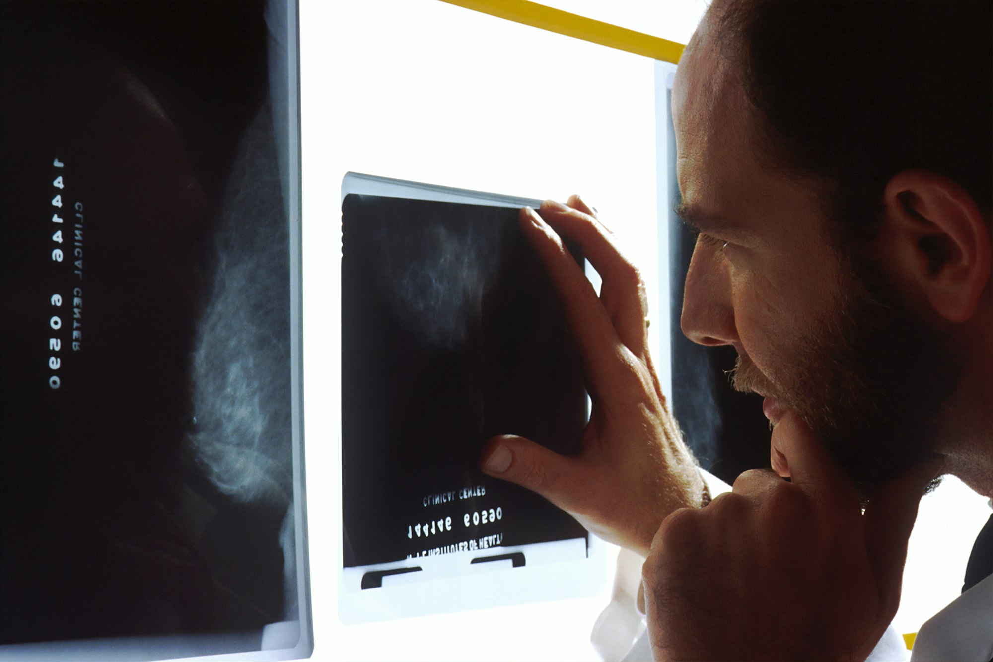A physician reviewing mammogram images on a light box
