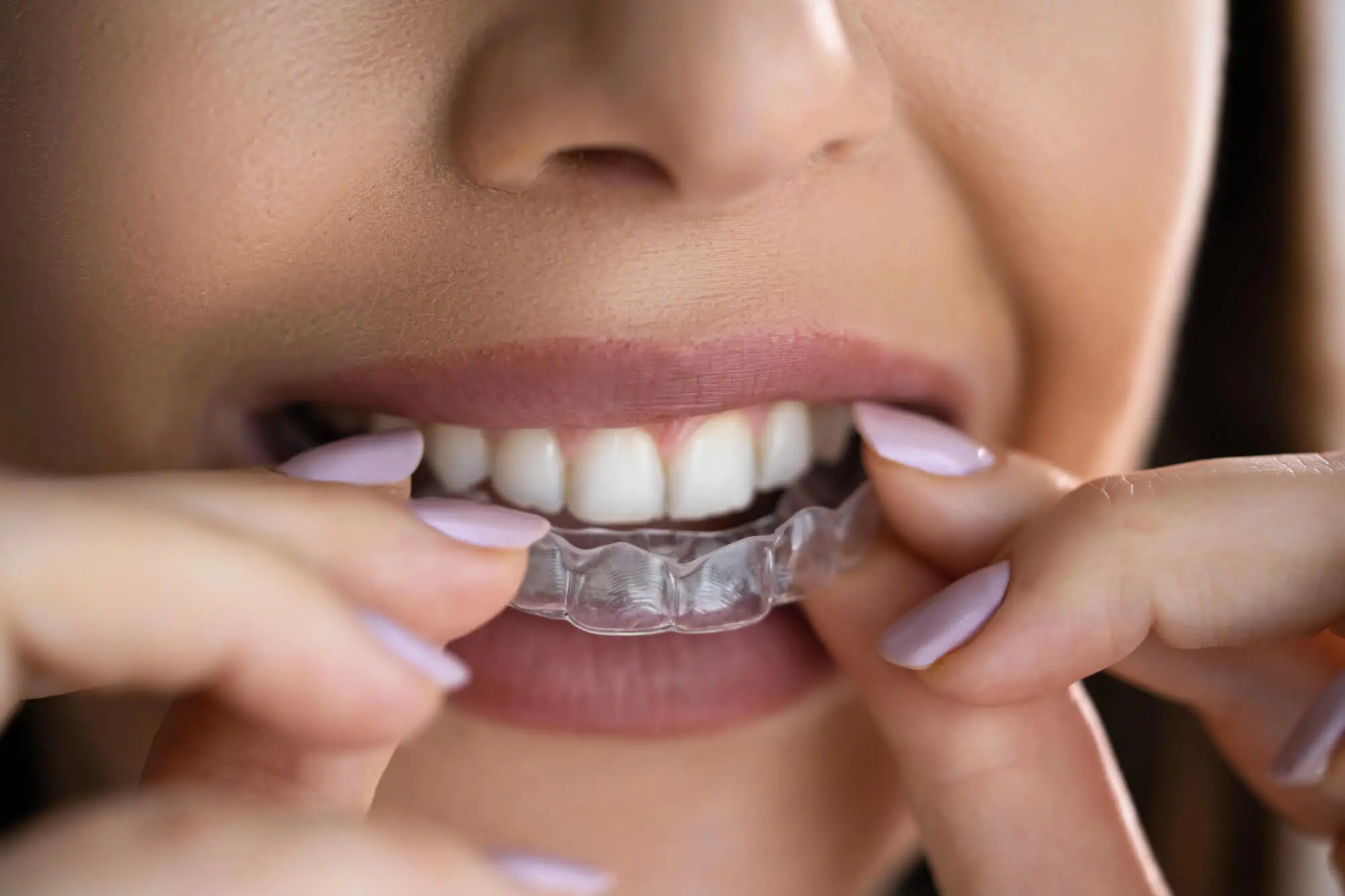 woman putting on her aligners