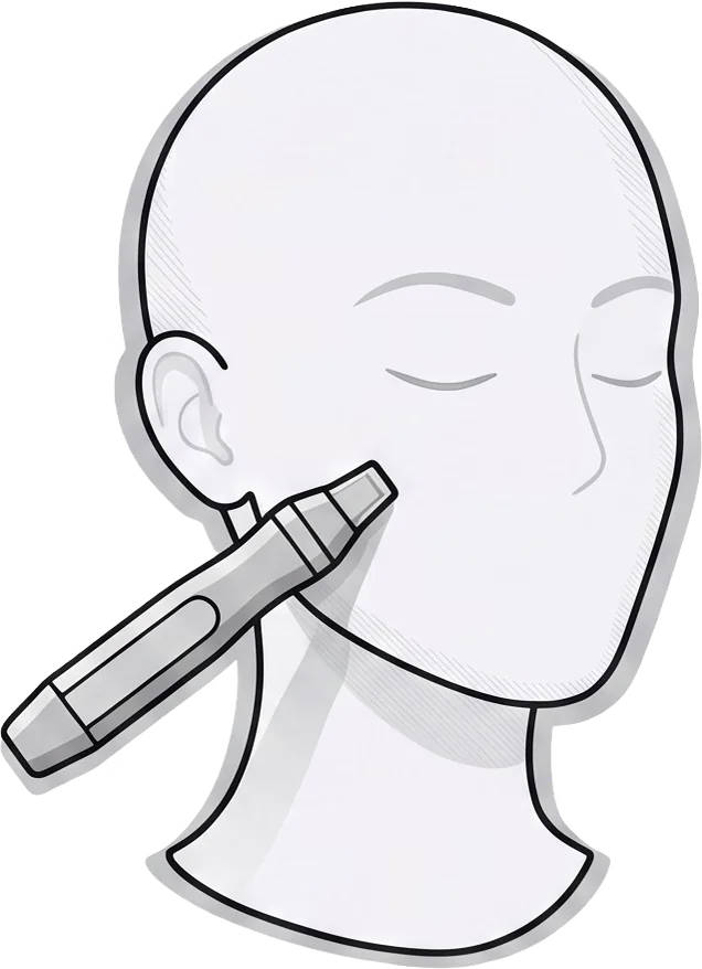 Illustration: RF-Microneedling-Handstück an der Wange während der Behandlung