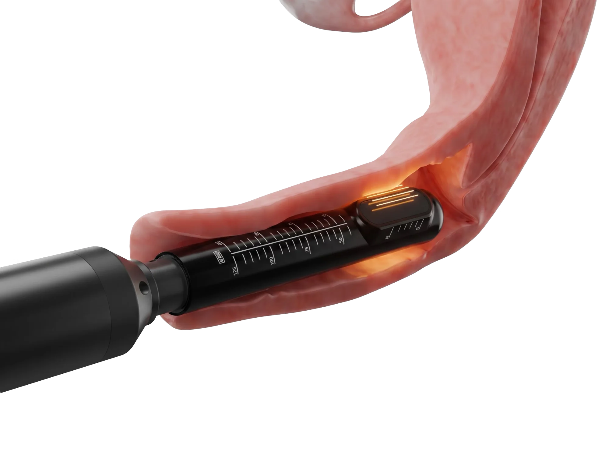 Anatomisches Schnittbild: die skalierte Sonde des Private-Handstücks liegt im Vaginalkanal, an ihrer Spitze treten fokussierte Ultraschalllinien in die Schleimhaut aus