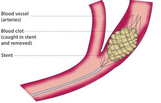 Clot removal with a stent retriever deployed across the clot before withdrawal