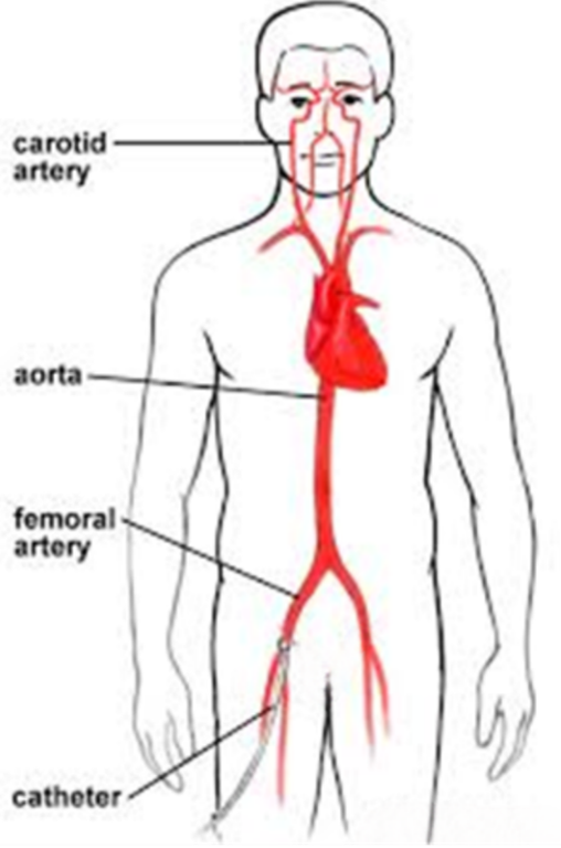 Microcatheter construction: inner liner, reinforcement layer, and outer jacket