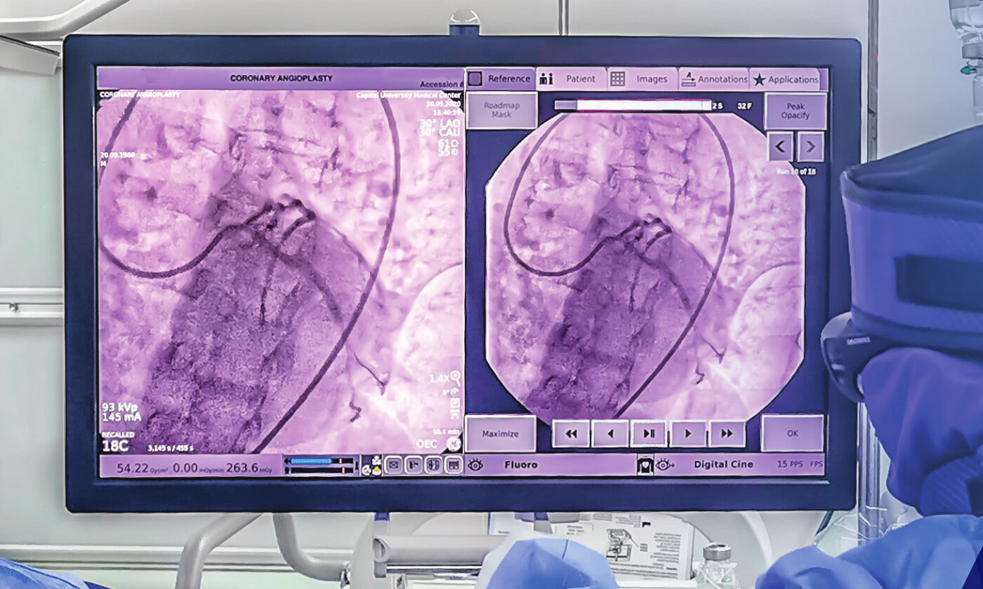 Cath lab monitor displaying coronary angiography images during an interventional procedure.