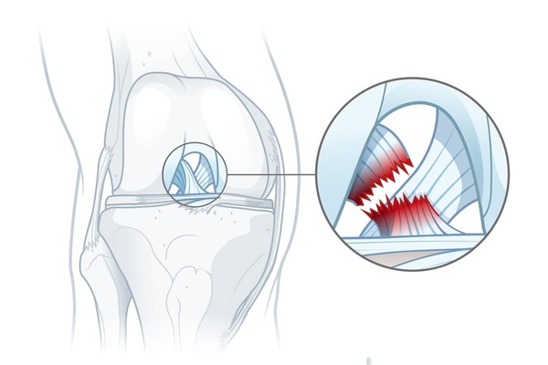 ACL Reconstruction