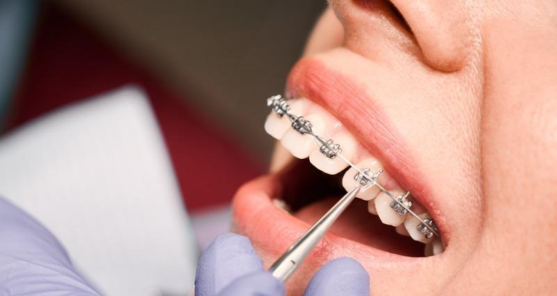 Traditional Metal Braces