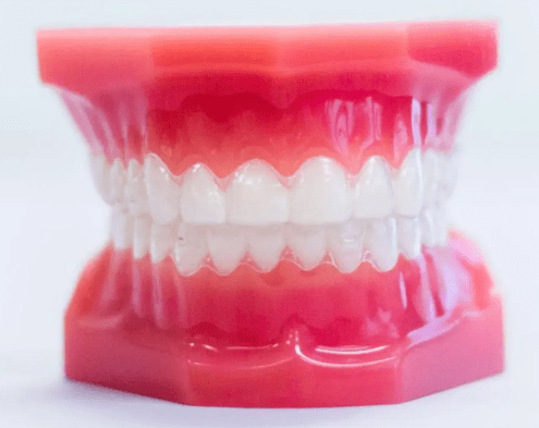 Clear Aligners (Invisalign)