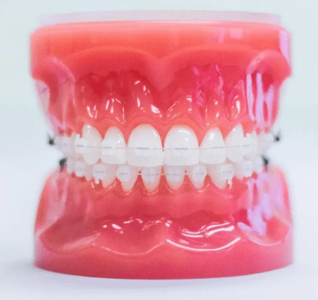 Orthodontics (Ages 11-13)