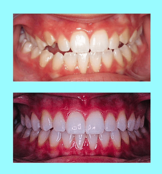 Orthodontics (Ages 6-10)
