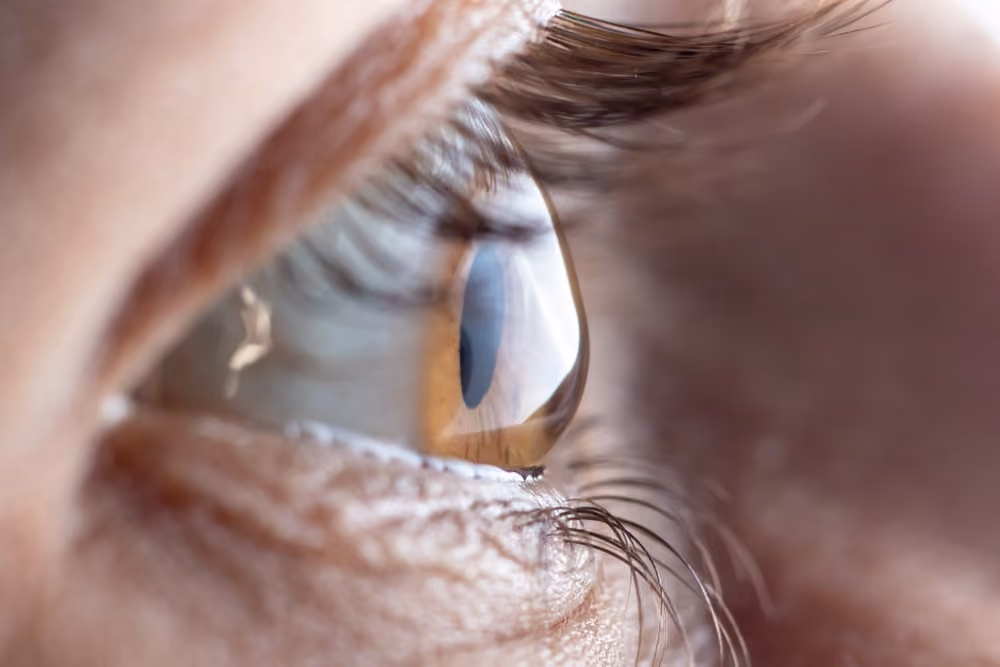 Close-up of a human eye affected by astigmatism