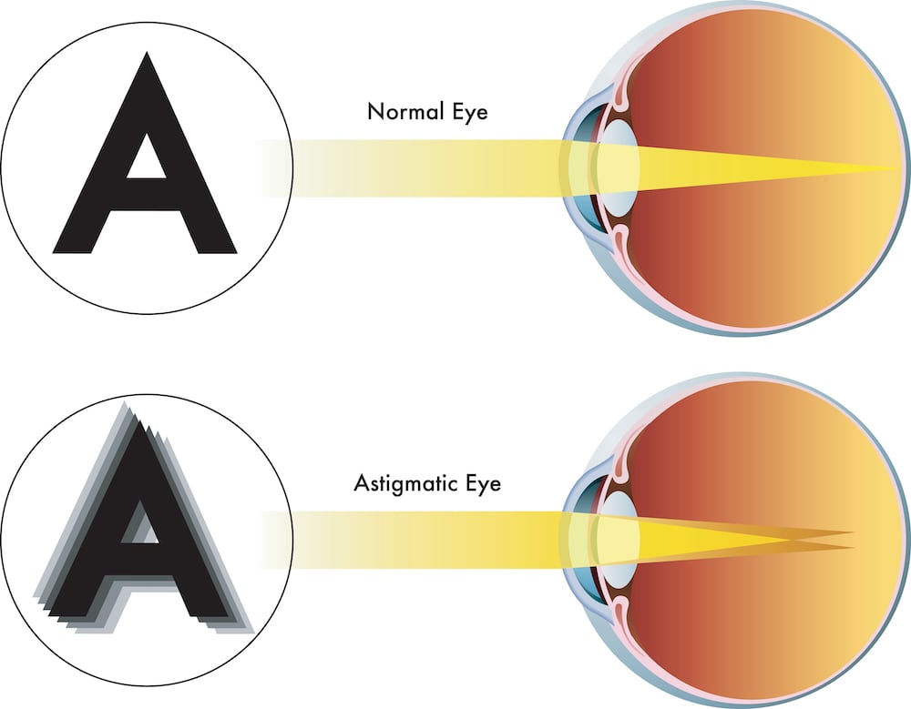Infographic showing how astigmatism affects the human eye