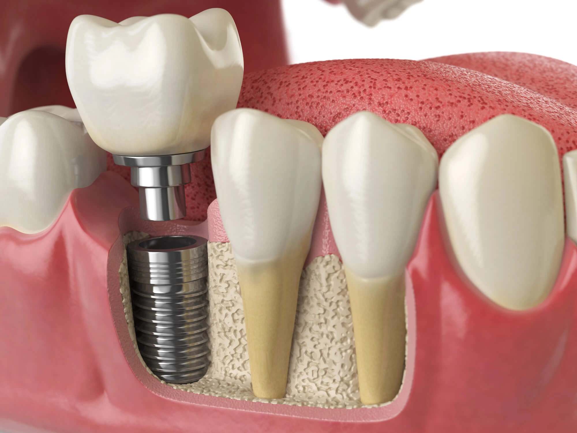 3D illustration of a dental implant being placed next to natural teeth in the jawbone.