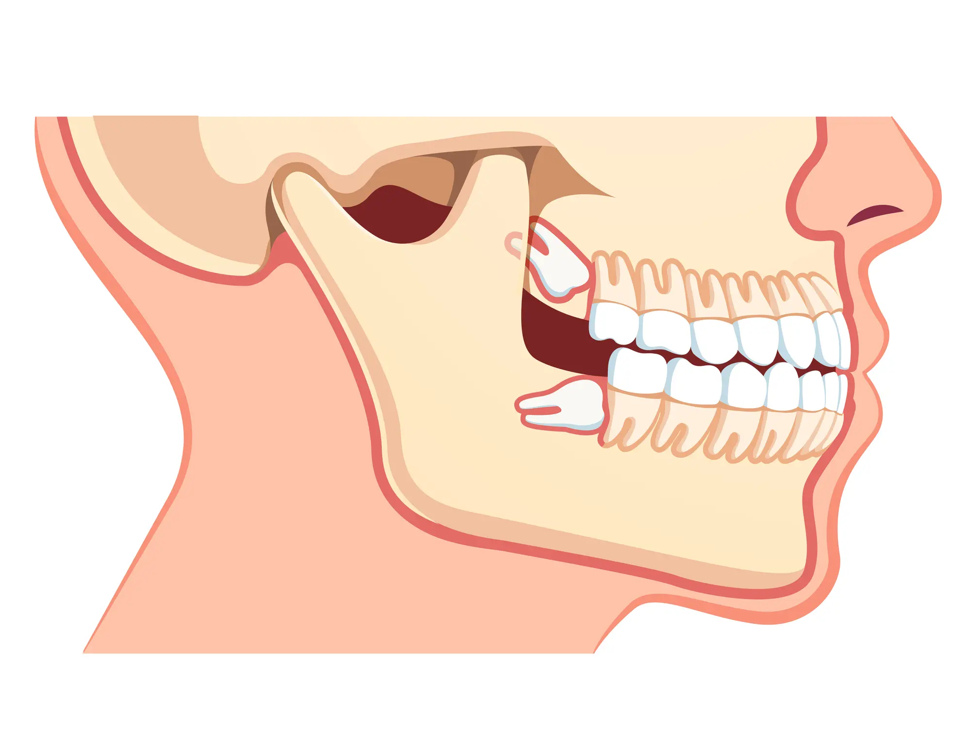 Side view illustration of a human skull with a focus on teeth showing an impacted wisdom tooth horizontally positioned under the gum.
