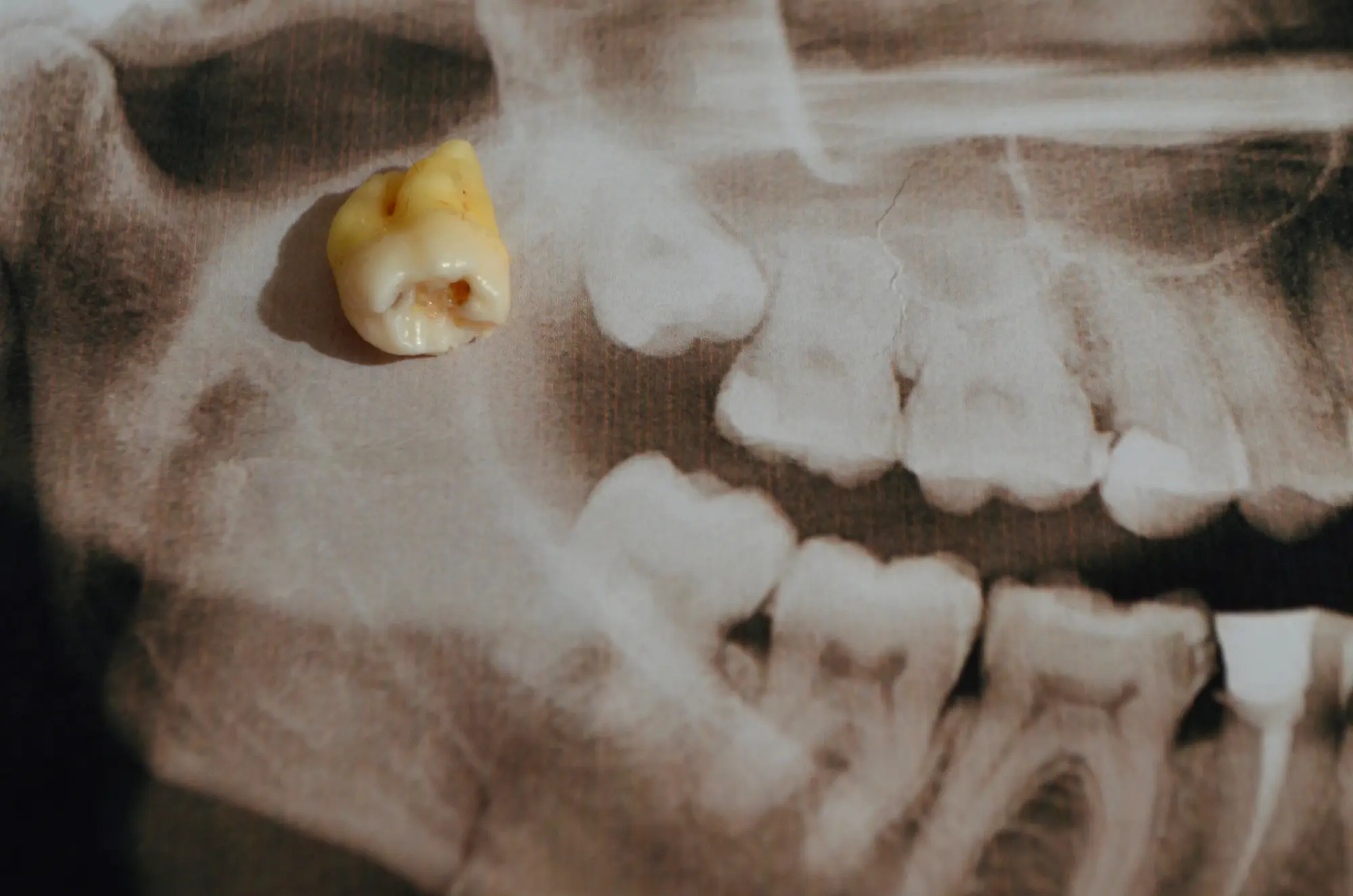 Extracted decayed tooth placed on a dental X-ray showing jaw and remaining teeth.