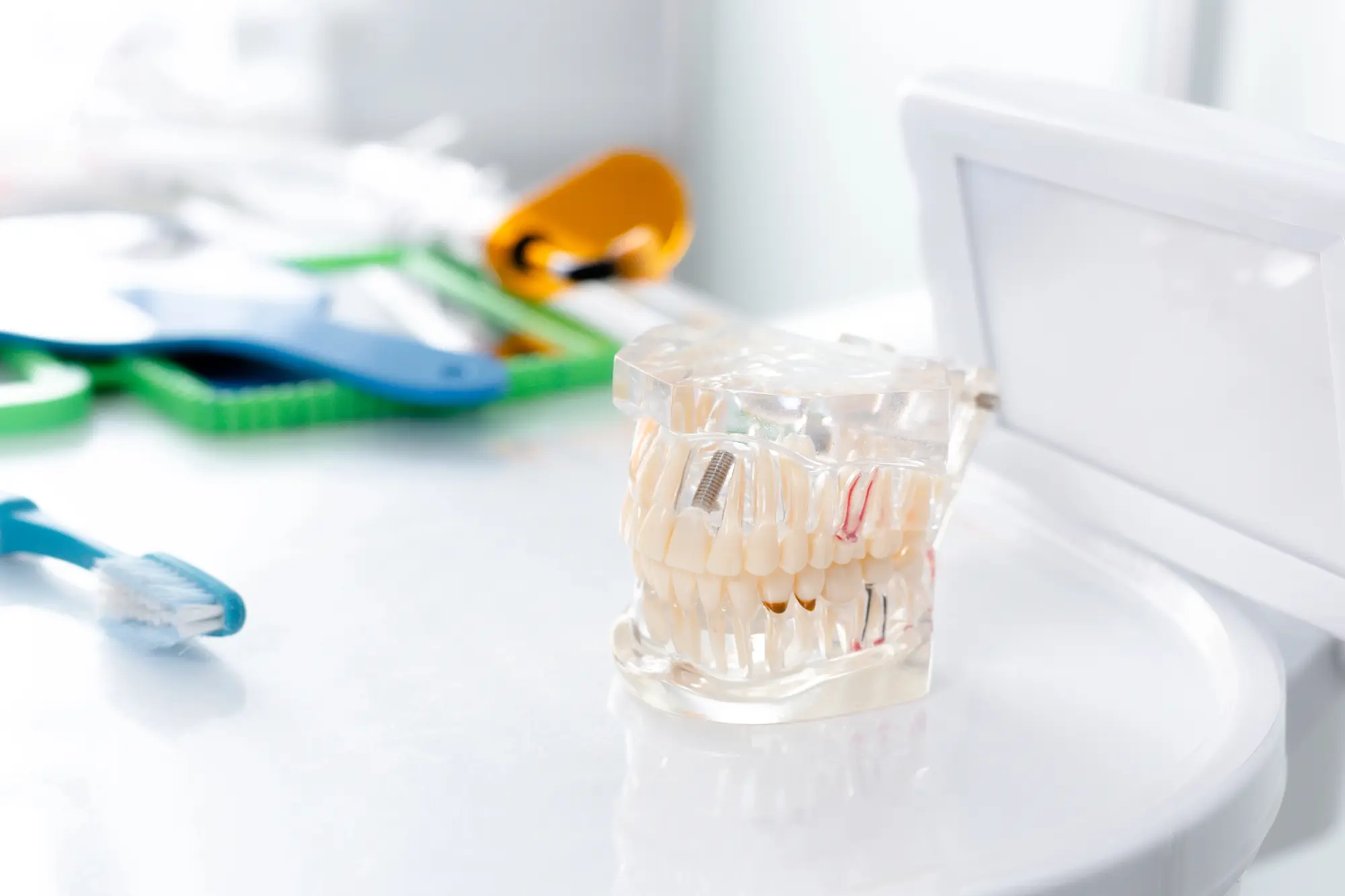 Dental model with teeth and implants on a white table with blurred dental tools in the background.